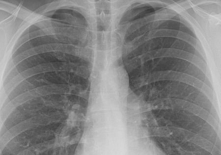 Tüdőszűrés Budakalászon